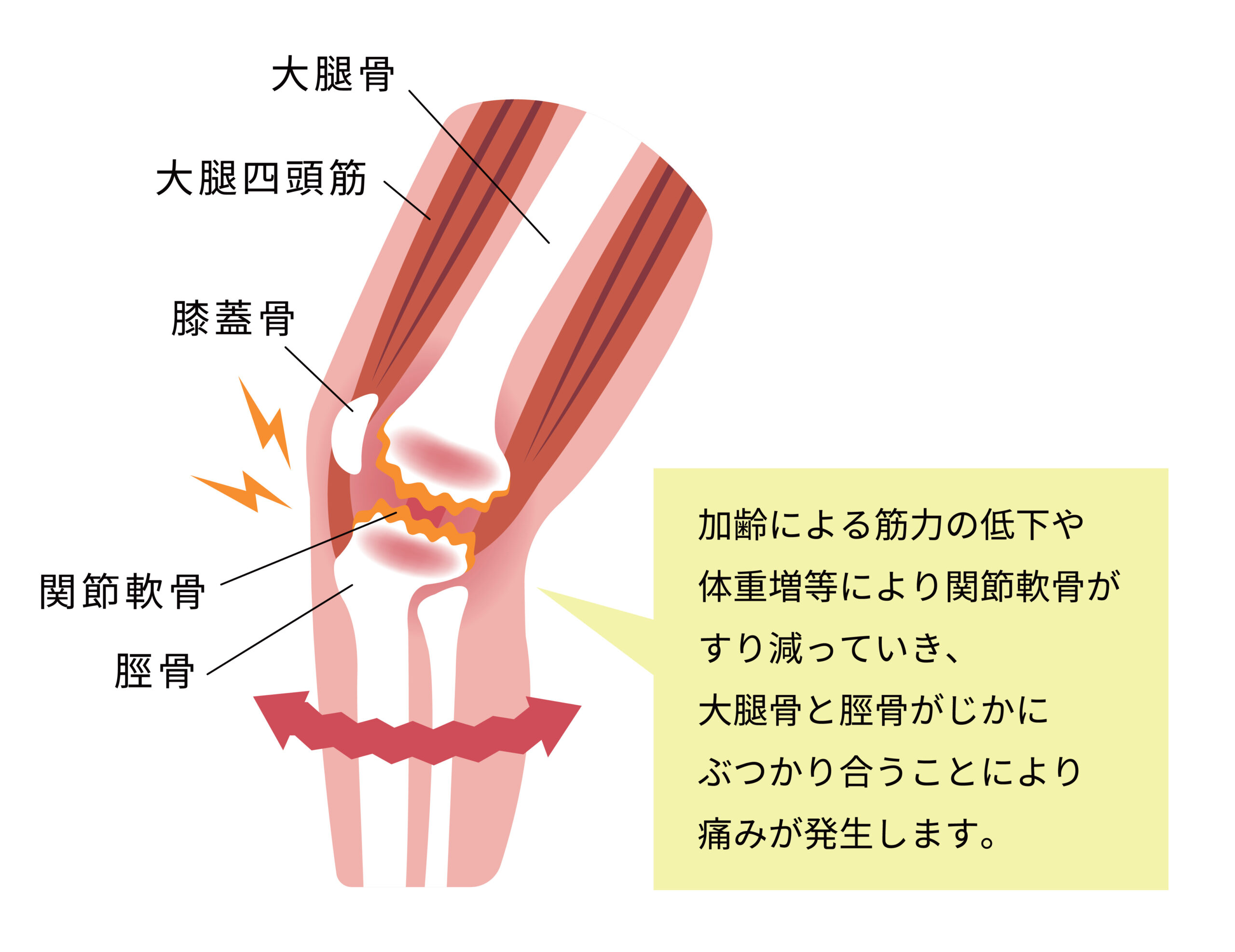 膝のO脚変形が気になりはじめたあなた！まだ自己矯正で間に合うかもしれませんよ！
