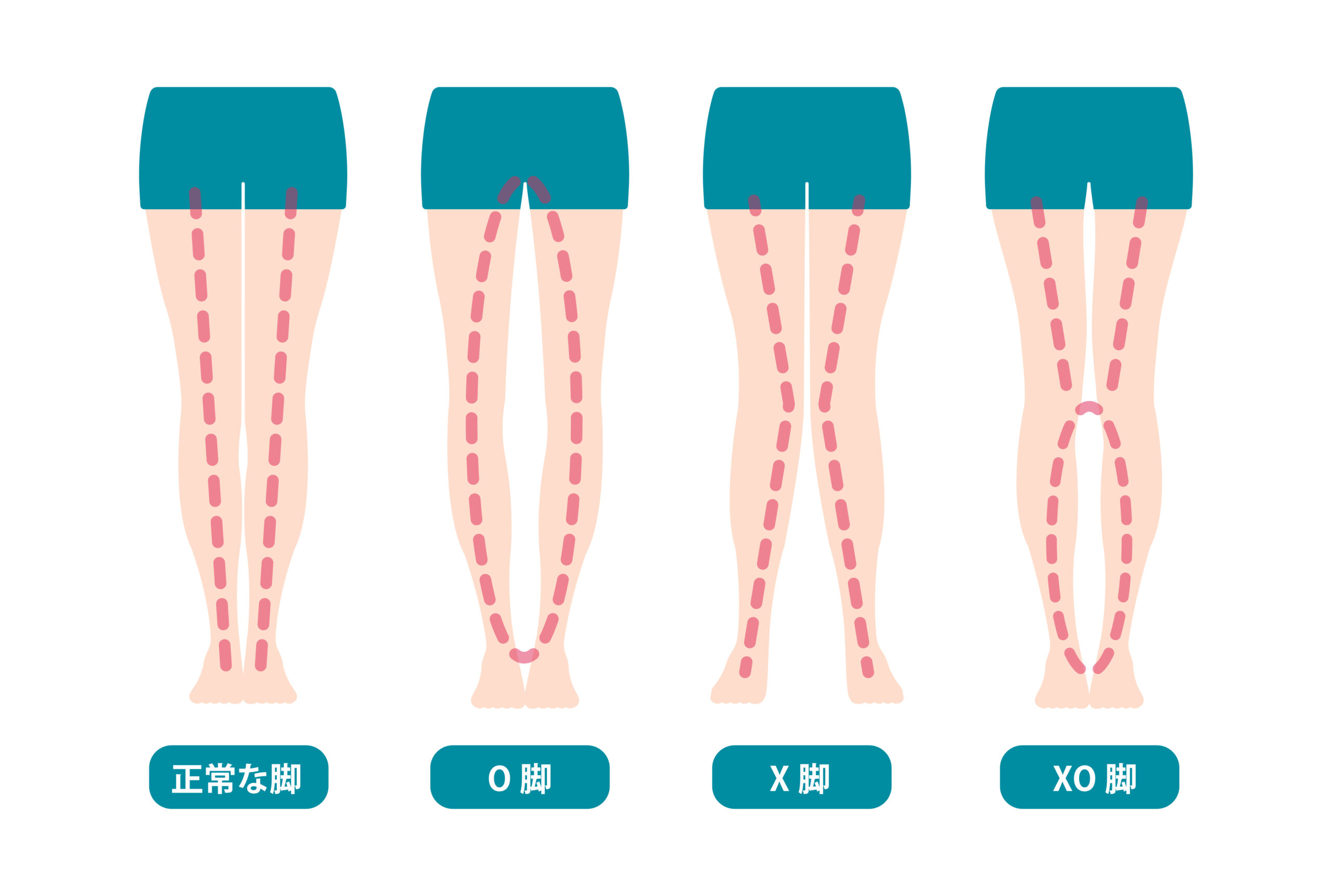 膝のX脚変形が気になりはじめたあなた！まだ自己矯正で間に合うかもしれませんよ！