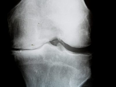 X-Ray image of knee joint with advanced arthrosis (Gonarthrose)