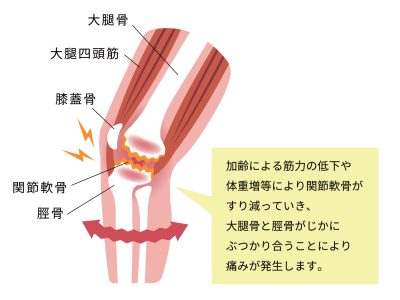 膝の関節痛（変形性膝関節症） 発生の仕組みと原因 イラスト
